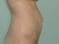 tummy tuck patient