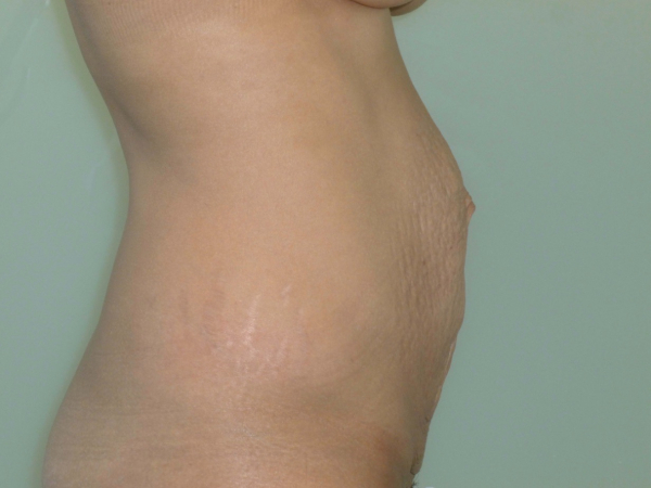 tummy tuck patient