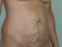 tummy tuck patient