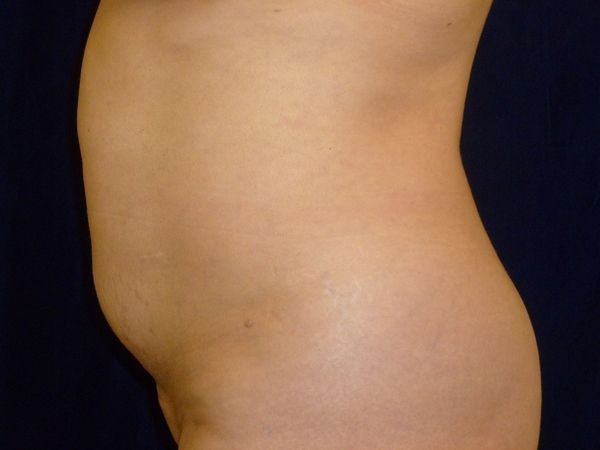 before brazilian butt lift left side view female patient case 3233
