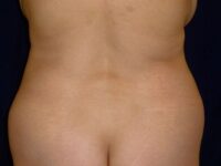 before brazilian butt lift back top view female patient case 3233