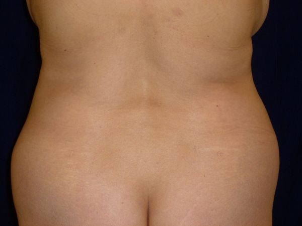 before brazilian butt lift back top view female patient case 3233