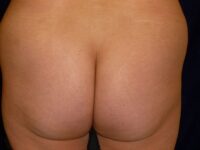 before brazilian butt lift back view female patient case 3233