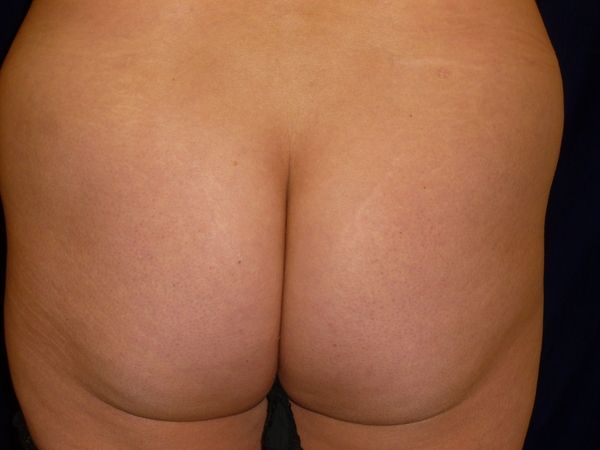 before brazilian butt lift back view female patient case 3233