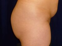 before brazilian butt lift right side view female patient case 3233