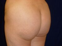 after brazilian butt lift left angle view female patient case 3233