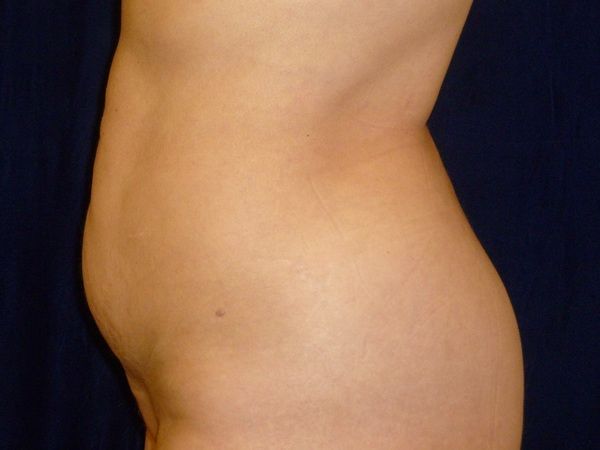 after brazilian butt lift left side view female patient case 3233
