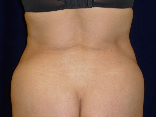 after brazilian butt lift back top view female patient case 3233