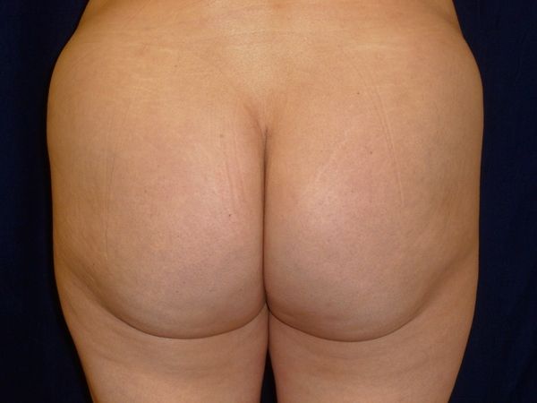 after brazilian butt lift back view female patient case 3233