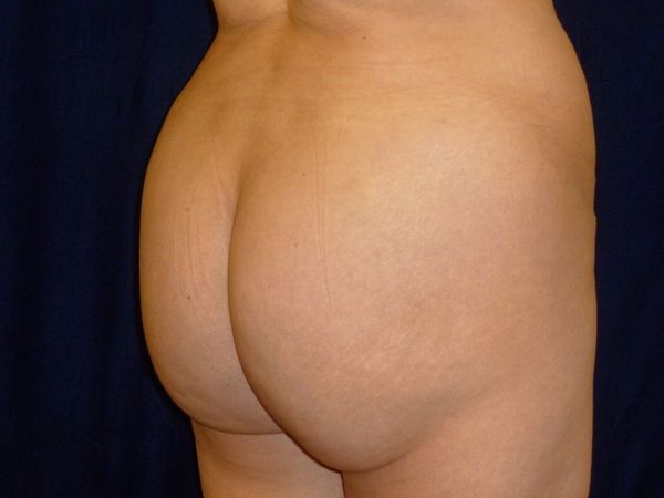 after brazilian butt lift right angle view female patient case 3233