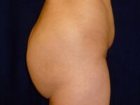 after brazilian butt lift right side view female patient case 3233