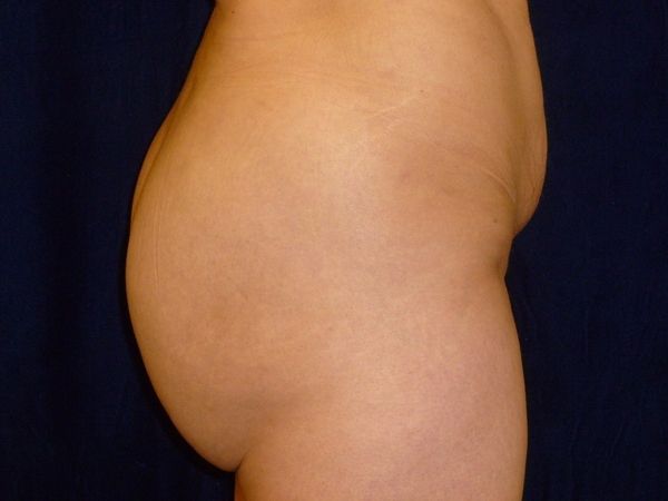 after brazilian butt lift right side view female patient case 3233