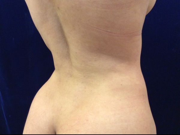 after brazilian butt lift back right angle view female patient case 3246