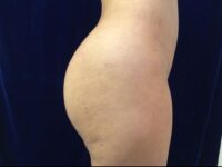after brazilian butt lift back right side view female patient case 3246