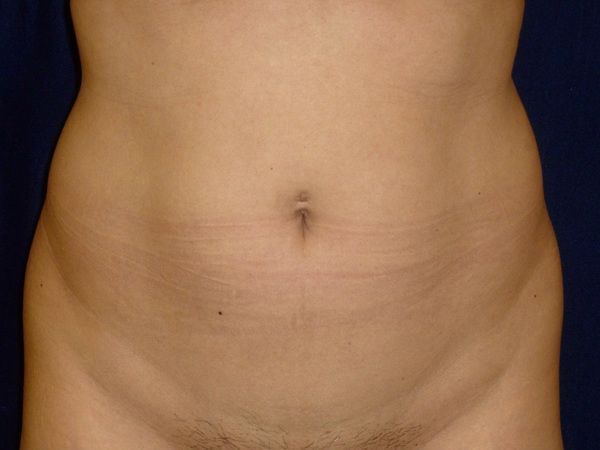 before brazilian butt lift lower front view female patient case 3246