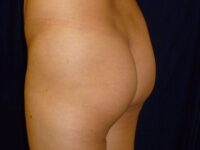 before brazilian butt lift lower back left angle view female patient case 3246