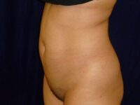 before brazilian butt lift back left angle view female patient case 3246