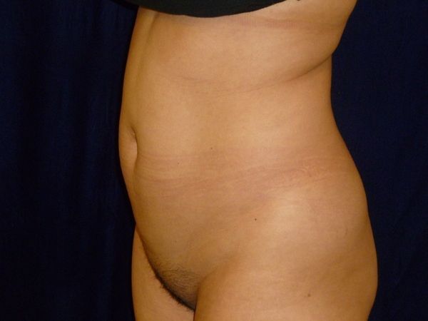 before brazilian butt lift back left angle view female patient case 3246