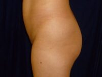 before brazilian butt lift back left side view female patient case 3246