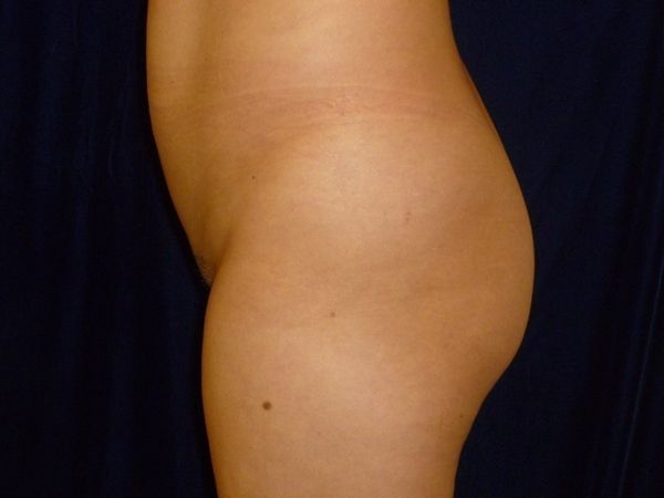 before brazilian butt lift back left side view female patient case 3246