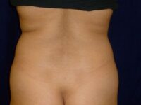 before brazilian butt lift back view female patient case 3246