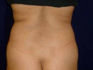 before brazilian butt lift back view female patient case 3246