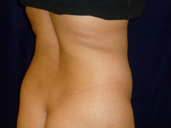 before brazilian butt lift back right angle view female patient case 3246
