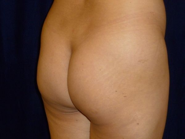 before brazilian butt lift lower back right angle view female patient case 3246