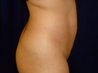 before brazilian butt lift back right side view female patient case 3246