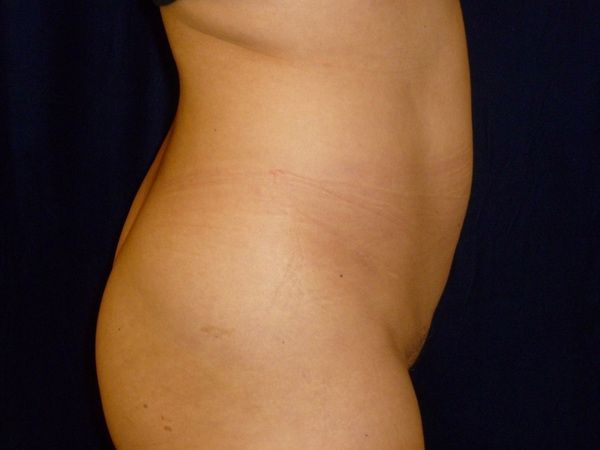before brazilian butt lift back right side view female patient case 3246