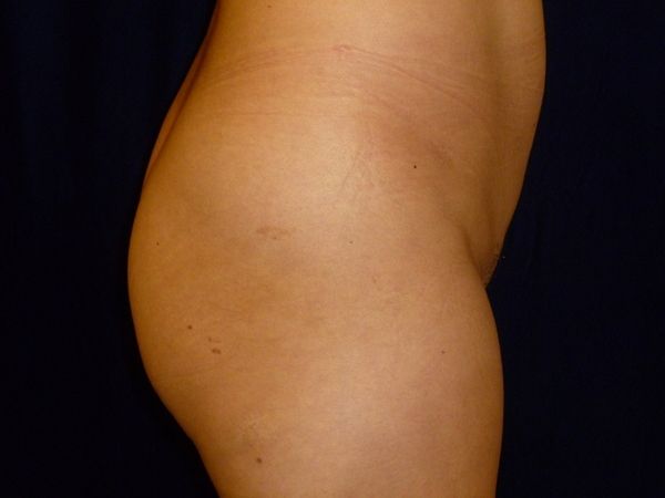 before brazilian butt lift right side view female patient case 3246