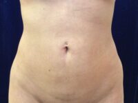 after brazilian butt lift lower front view female patient case 3246