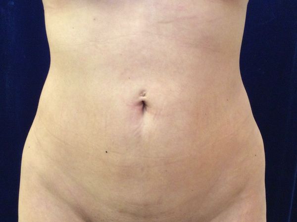 after brazilian butt lift lower front view female patient case 3246
