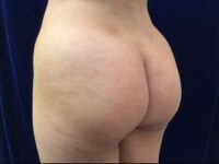 after brazilian butt lift lower back left angle view female patient case 3246