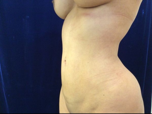 after brazilian butt lift back left angle view female patient case 3246