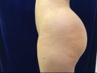 after brazilian butt lift back left side view female patient case 3246