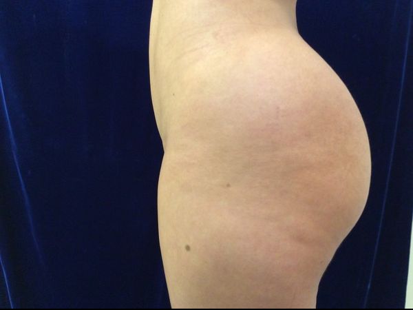 after brazilian butt lift back left side view female patient case 3246