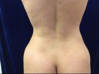 after brazilian butt lift back view female patient case 3246