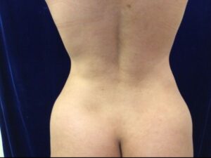 after brazilian butt lift back view female patient case 3246