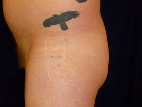 before Brazilian butt lift left closeup view male patient case 3514