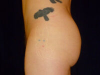 after Brazilian butt lift left view male patient case 3514