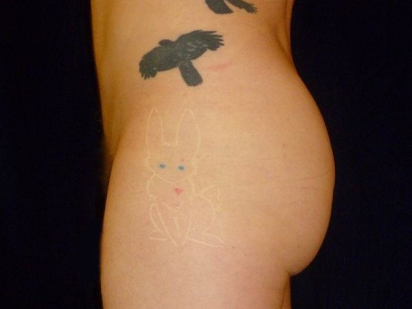 after Brazilian butt lift left view male patient case 3514