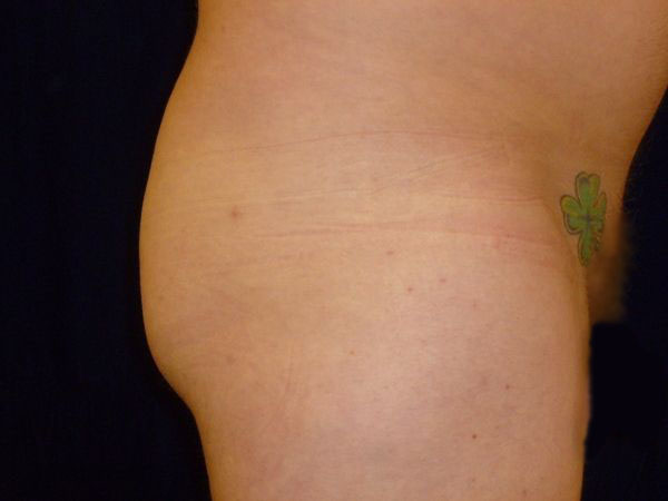 before Brazilian butt lift right closeup view male patient case 3514