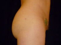 after Brazilian butt lift right view male patient case 3514
