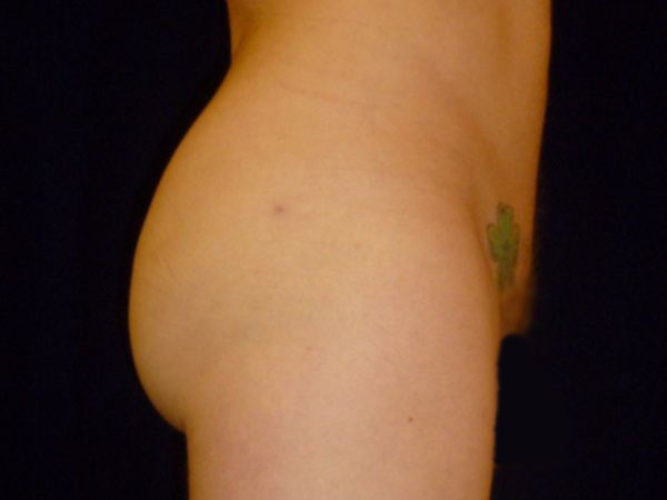 after Brazilian butt lift right view male patient case 3514