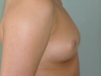 before breast augmentation right side view female patient case 3330