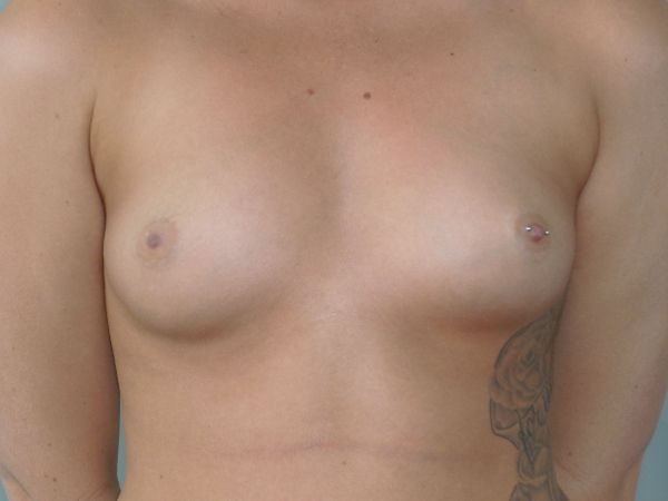 before breast augmentation front view female patient case 3330