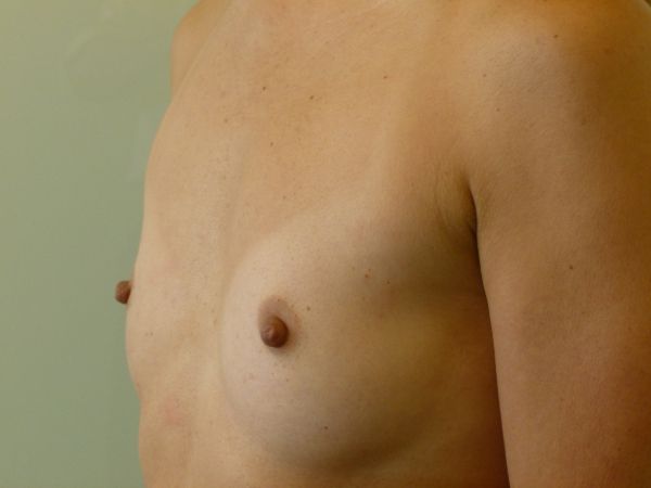 before breast augmentation left angle view female patient case 3341