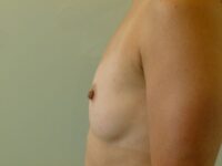 before breast augmentation left side view female patient case 3341