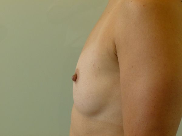 before breast augmentation left side view female patient case 3341